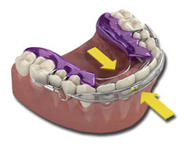Inman Dental Aligner